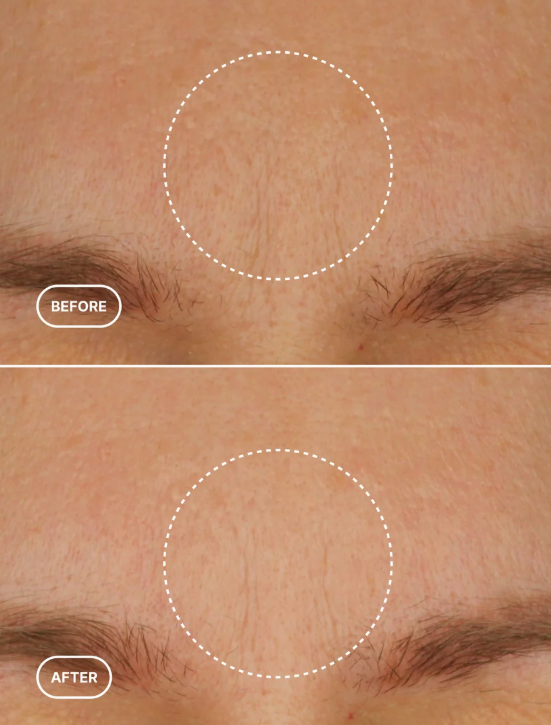 Before and after comparison of skin texture on a person's face.