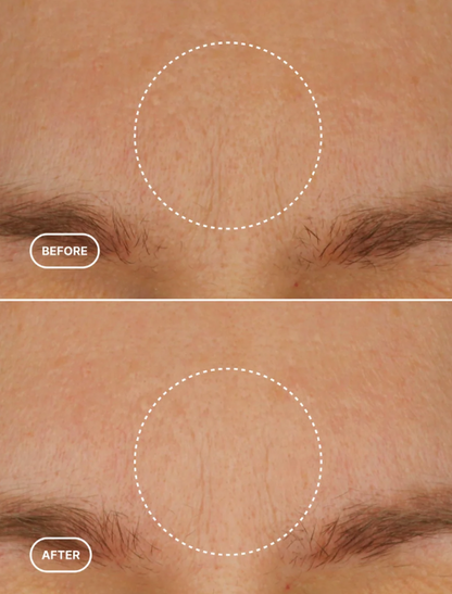 Before and after comparison of skin texture on a person's face.