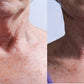 Before and After Neck Wrinkle Treatment with Flux Halo