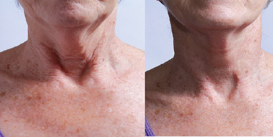 Before and After Neck Wrinkle Treatment with Flux Halo