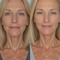 Before and After Wrinkle Treatment with Flux Halo Complete Kit