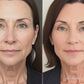 Before and After Eye Wrinkle Treatment with Flux Halo