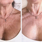 Before and After Décolleté Wrinkle Treatment with Flux Halo