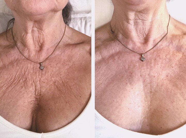 Before and After Décolleté Wrinkle Treatment with Flux Halo
